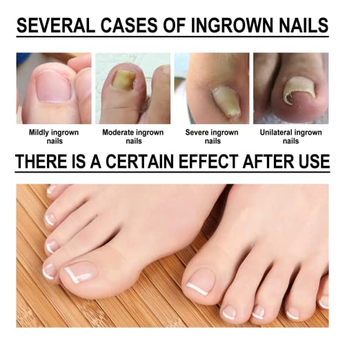 Ingrown Toenail Treatment Drop- Ingrown Toenail Treatment- Cuticle Care Oils for Ingrown Toenails - Trimming Toenail Softening Drops Natural Ingr