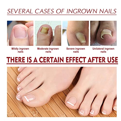 Ingrown Toenail Treatment,Nail Helper,Nail Growth Treatment,Ingrowing Toenail Treatment,Ingrown Toenail Corrector,Treatment For Ingrown Toenail,I