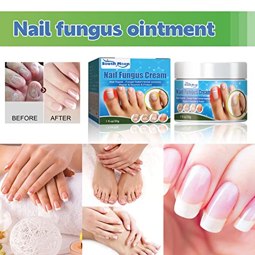 Nail Fungus Treatment Cream, 30g Strong Anti-Fungus Nail Treatment for Toenail Fungus, Fungal Nail Treatment For Athlete's Foot and Nail Infectio