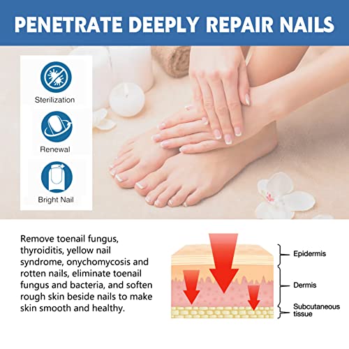 Nail Fungus Treatment Cream, 30g Strong Anti-Fungus Nail Treatment for Toenail Fungus, Fungal Nail Treatment For Athlete's Foot and Nail Infectio