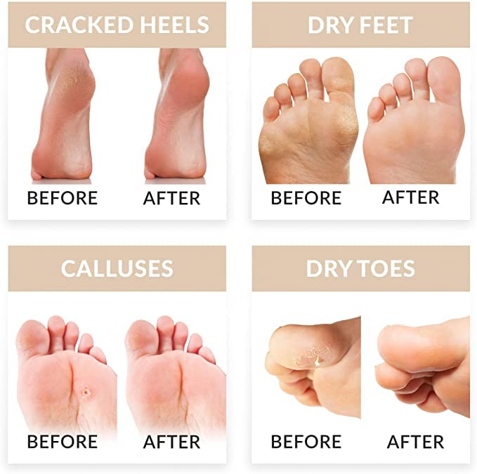 Foot Peel Mask WOOZHI, 2 Pack Foot Peeling Mask for Soft Baby Feet - Hard Skin Remover Foot Mask, Rose Foot Mask,Removes Calluses and Hard Skin,m