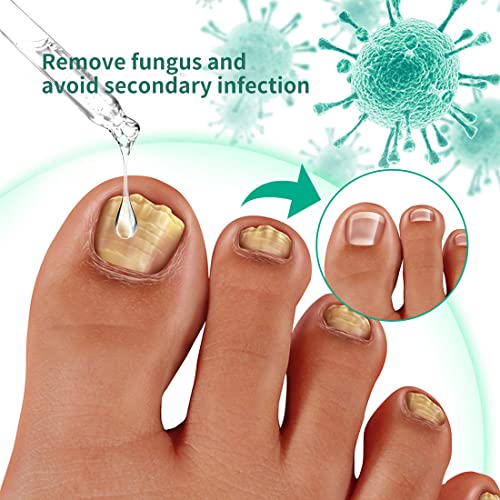 Kerassentials Toenail Fungus Treatment Oil, Best Repair Solution for Fingernails and Toenails, Fix & Renew Damage Fungal Nail, Broken, Cracked &