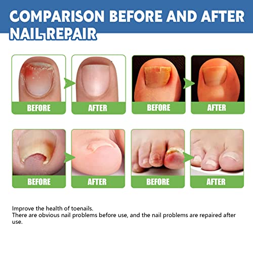 Nail Fungus Treatment Cream, 30g Strong Anti-Fungus Nail Treatment for Toenail Fungus, Fungal Nail Treatment For Athlete's Foot and Nail Infectio