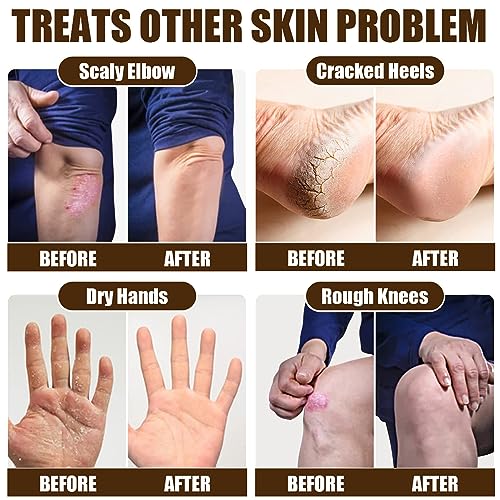 Cracked Skin Repair Cream,Foot Repair Cream,Anti Crack Heel Balm,Quickly Cracked Heel Repair Cream,Feet & Lip & Leg,Foot Cream For Cracked Heels