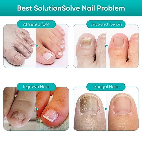 Chinoxia Fungal Nail Treatment, Extra Strong Nail Fungus Treatment for Toenail, Nail Repair Kit with File and Brush -30ml