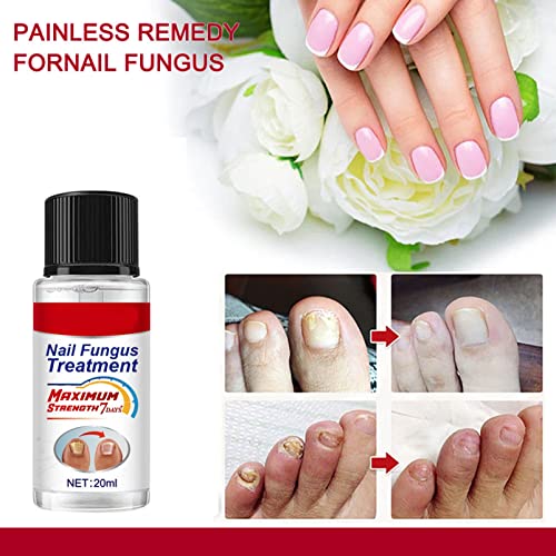 Fungal Nail Treatment 20ml, Extra Strong Nail Fungus Treatment for Toenail and Fingernail, Premium Fungal Nail Eliminator, Anti fungus Nail Repai