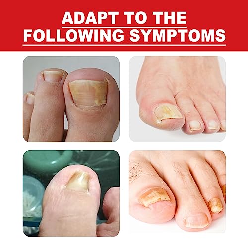 Ingrown Toenail Treatment,Fungal Nail Treatment,Ingrown Toenail Drops,Nail Care and Treatment,Strengthen Renew Damaged Nail(30ML)
