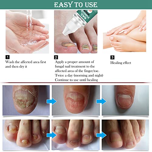 Fungal Nail Treatment for Toenail Extra Strong, Ingrown Toenail Treatment Nail Care Oils, Anti Toe Nail Fungus Treatment for Toenail Nail Fungal